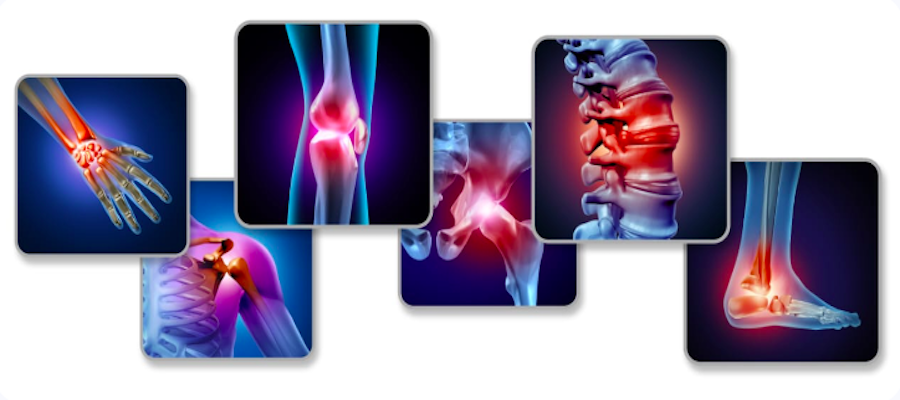 rheumatoid arthritis pain and inflammation
