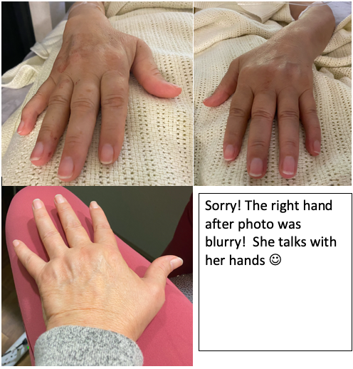 Rheumatoid Arthritis before and after 7 day treatment